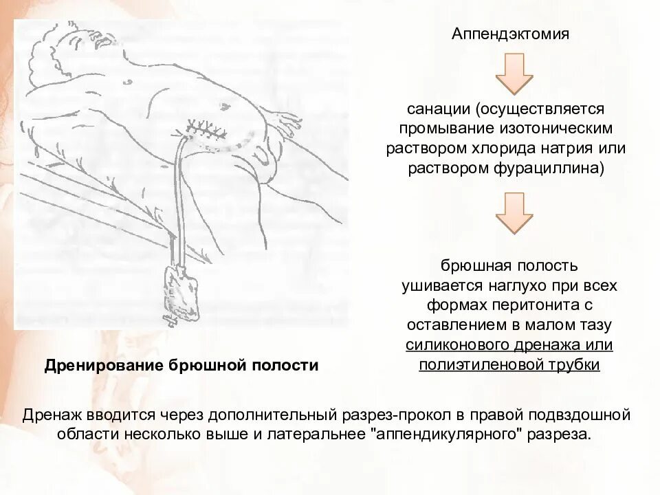 Как болит аппендицит у ребенка. Как болит аппендицит у ребенка
