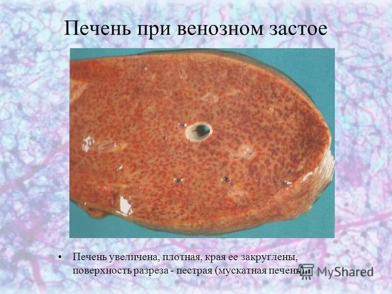 Застой печени лечение. Мускатная печень макропрепарат. Венозное полнокровие печени мускатная печень. Мускатная печень патанатомия макропрепарат. Ложно мускатная печень макропрепарат.