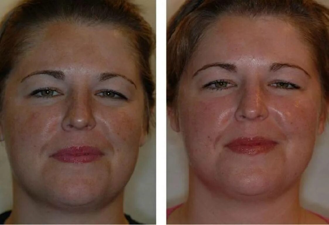 Молочный пилинг лица skinlift ru. Химический кислотный пилинг. Кислотный пилинг для лица до и после. Кислотный пилинг для лица после.