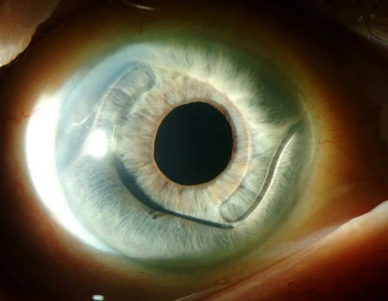 Искусственные хрусталик карл цейс. Мультифокальные иол катаракта. У людей с искусственным хрусталиком глаза. Подшивание иол к радужке. Иол panoptix toric.