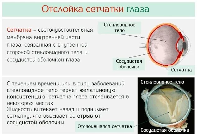 Отслоение сетчатки глазное дно. Регматогенная отслойка сетчатки симптомы. Причины первичной отслойки сетчатки. Назовите основные методы лечения отслойки сетчатки.. Стекловидное тело операция