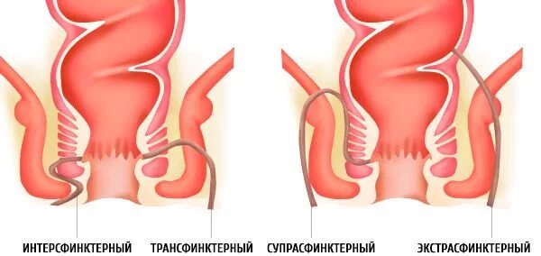 Свищ заднего прохода фото и лечение Сфинктер заднего: найдено 89 картинок
