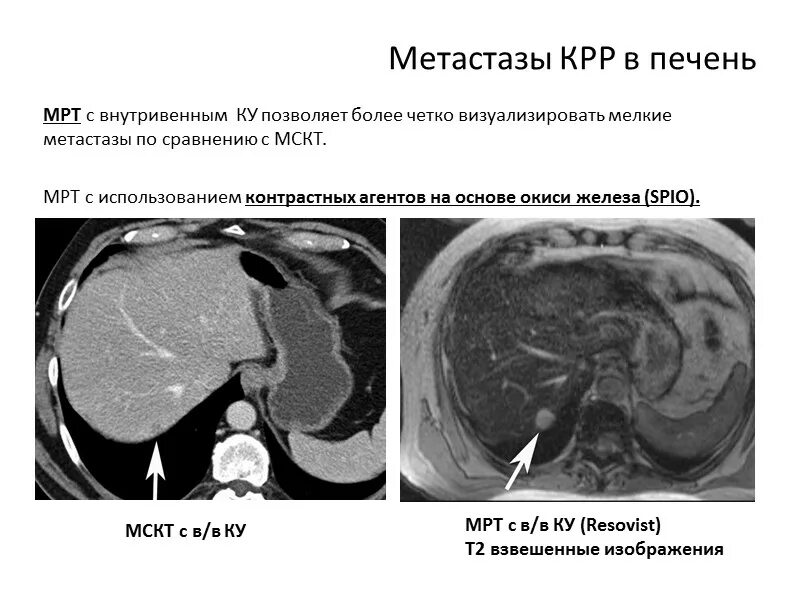 Вылечить метастазы в печени. Объемные образования печени на мрт. Гиповаскулярные метастазы. Мрт печени новообразование.