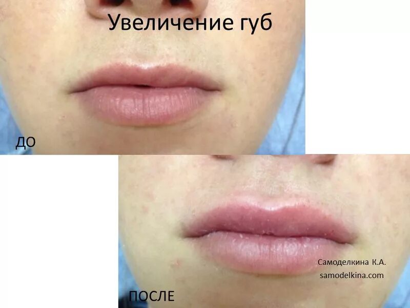 Губы 1.5 мл до и после зажившие Накачать губы в Петровском: 120 косметологов с отзывами и ценами на Яндекс Услуг