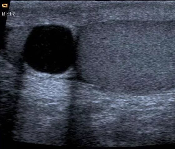 Киста у мужчин на узи. Эпидермоидная киста яичка УЗИ. Киста белочной оболочки яичка УЗИ. Киста семенного канатика на УЗИ. Киста белочной оболочки УЗИ.