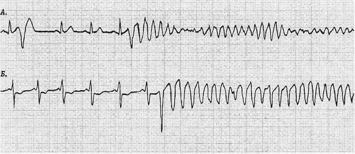 Желудочковая фибрилляция на ЭКГ. Фибрилляция желудочков на ЭКГ. Трепетание желудочков на ЭКГ. Мелковолновая фибрилляция желудочков ЭКГ.