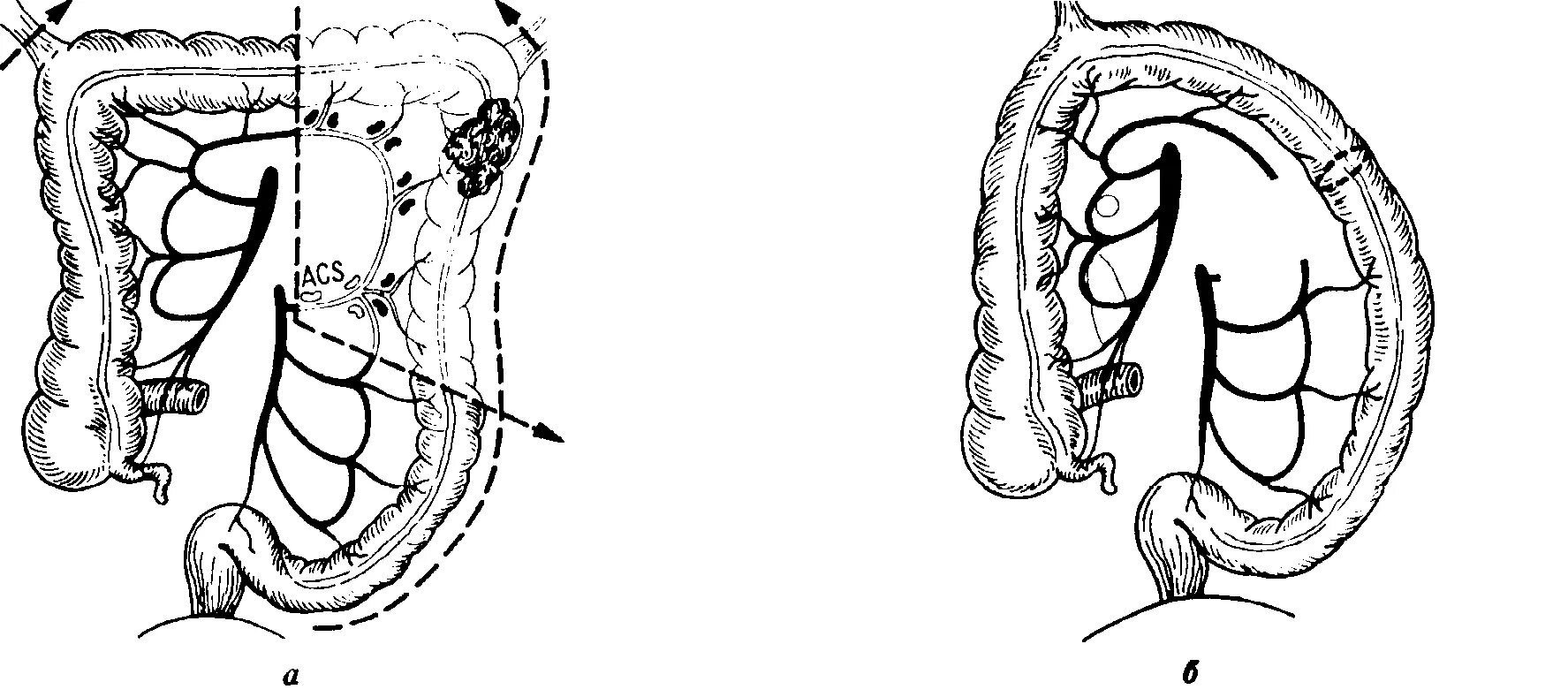 Операция толстой. Резекция селезеночного изгиба толстой кишки. Обходной анастомоз кишечника. Резекция толстой кишки операция. Обходной анастомоз толстой кишки.