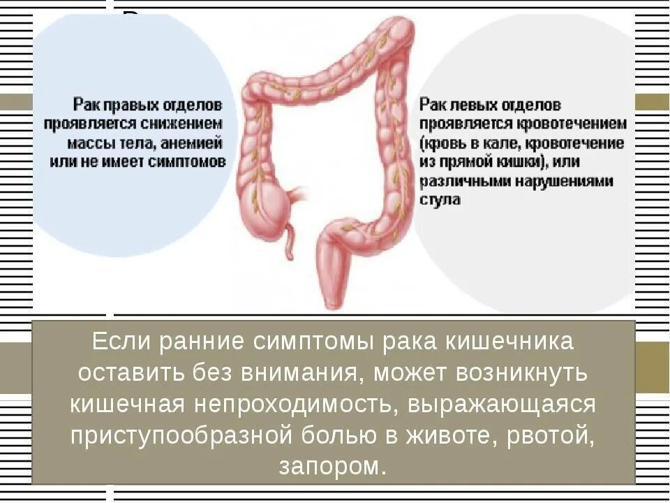 Какие признаки рака кишечника у женщин симптомы. Симптотмырака кишечника. РПК кишечника симптому. Симптомы ракткишечника.