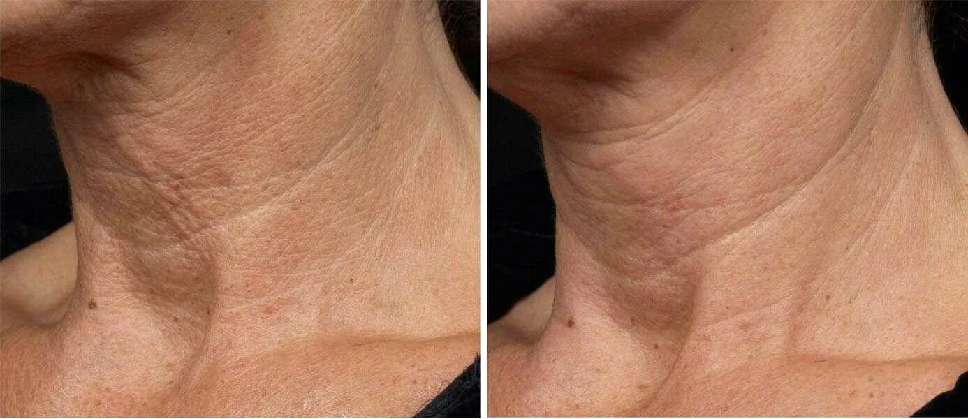 Как убрать морщины на шее. Складки на шее кольца венеры. Как убрать морщины на шее. Кольца венеры на шее до и после. Вертикальные морщины на шее.