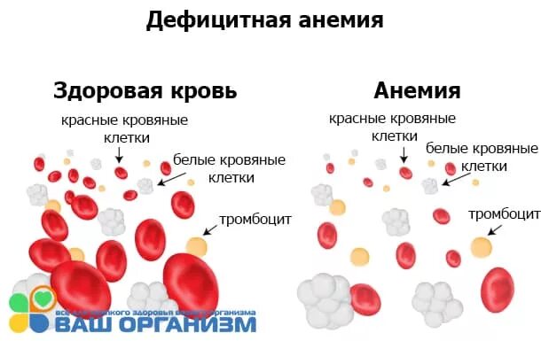 Анемия это заболевание крови. Кровь здорового человека. Анемия иллюстрация.