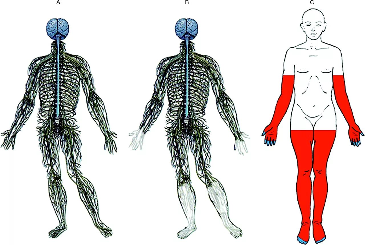 Нейропатия справа. Нерв алкогольная нейропатия. Поражение периферических нервов нижних конечностей. Диабетическая полинейропатия нижних конечностей сенсорная форма. Дистальная сенсорная полинейропатия.