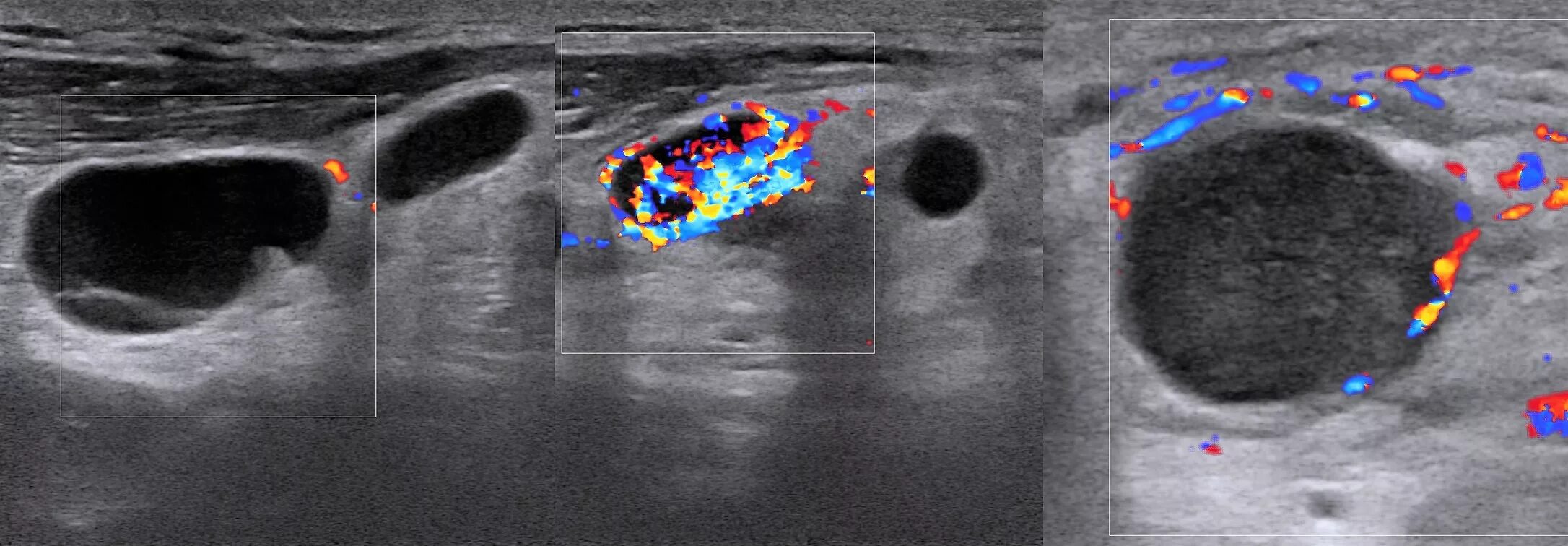 Лимфатический узел щитовидной железы УЗИ. Метастазы в щитовидной железе на УЗИ. Аксиллярные лимфоузлы УЗИ. Фолликулярная киста ЧЛО. Жидкость в лимфоузле