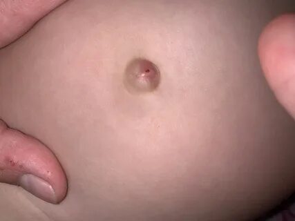 Пупок у ребёнка - Вопрос детскому хирургу - 03 Онлайн