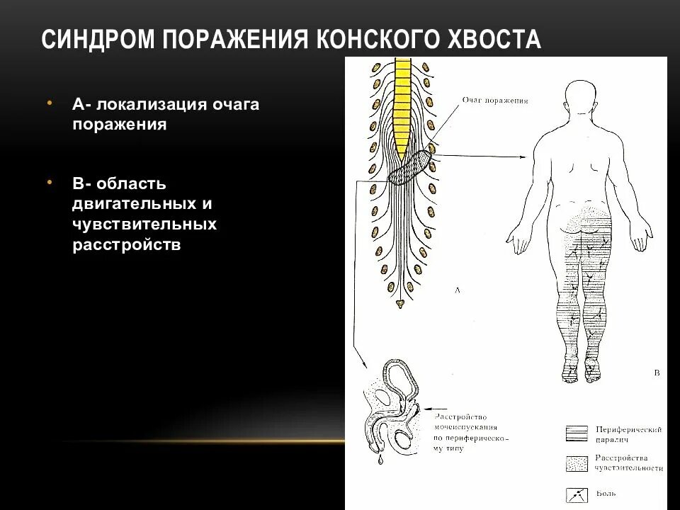 Симптомы поражения конского хвоста. Синдром компрессии Корешков конского хвоста. Симптомы компрессии Корешков конского хвоста. Синдромы поражения конского хвоста спинного мозга.