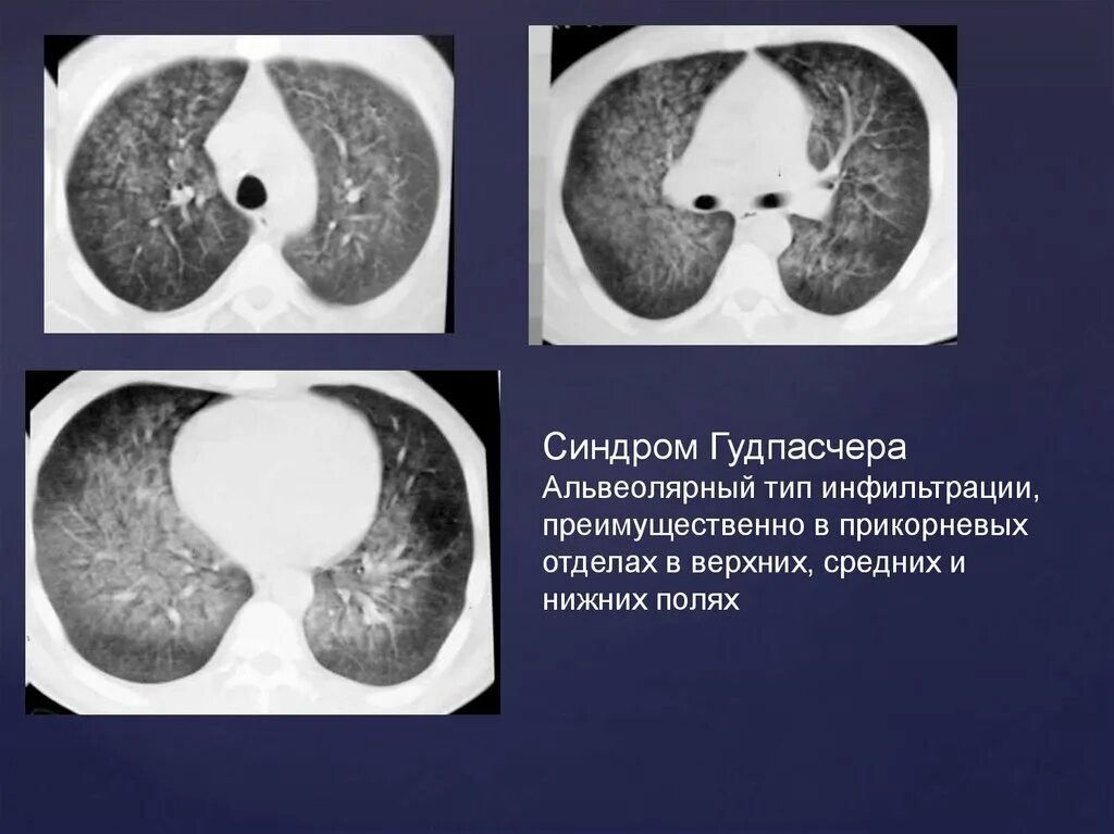 Диффузно инфильтративная. Синдром Гудпасчера патогенез. Синдром Гудпасчера гистология. Поражение легких при синдроме Гудпасчера. Гудпасчера кт легких болезнь.