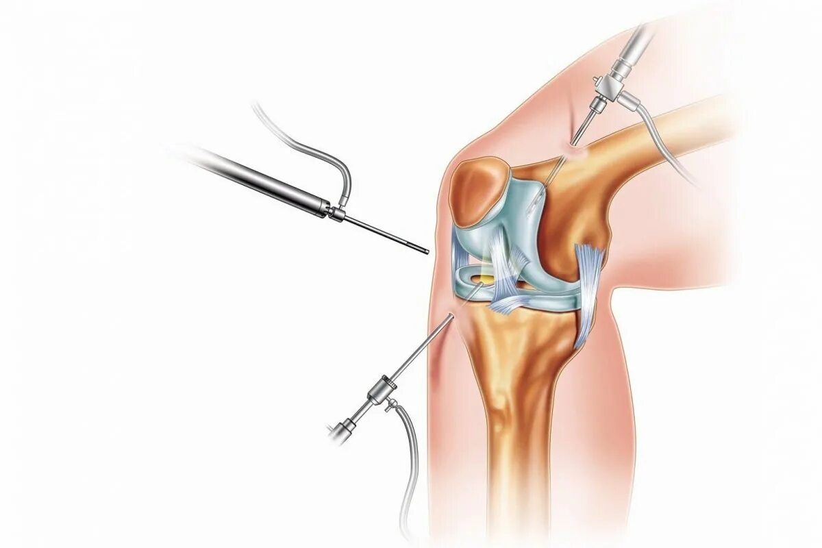 Артроскопическая ревизия коленного сустава, резекция. Операция на мениске артроскопия. Операция артроскопия коленного сустава. Мениск коленного сустава операция. Восстановление после операции на коленном