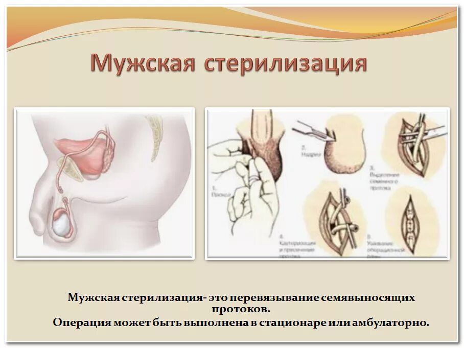 Химическая кастрация людей. Камустрация у человека. Химическая кастрация мужчин.