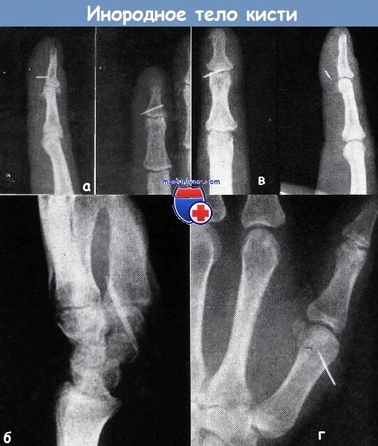 Инородное тело пальца кисти. Инородное тело кисти рентген. Инородное тело мягких тканей кисти. Инородное тело в пальце руки.
