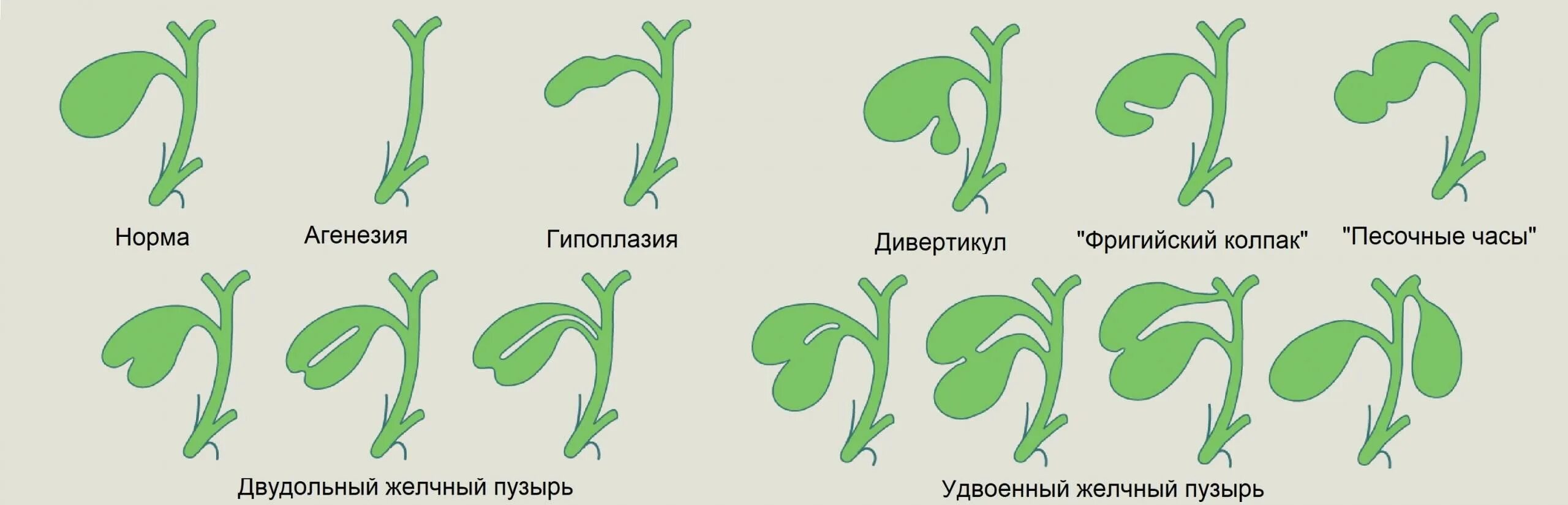 Деформация желчного пузыря перегибом. Классификация атрезии желчных протоков. Пороки развития желчного пузыря. Аномалия строения желчного пузыря. Желчный изгиб у ребенка