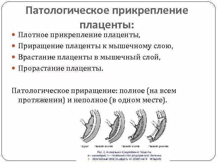 Плотное прикрепление плаценты классификация. Патогенез плотного прикрепления плаценты. Полное плотное прикрепление плаценты. Плотное прикрепление и приращение плаценты. Плацента на рубце матки