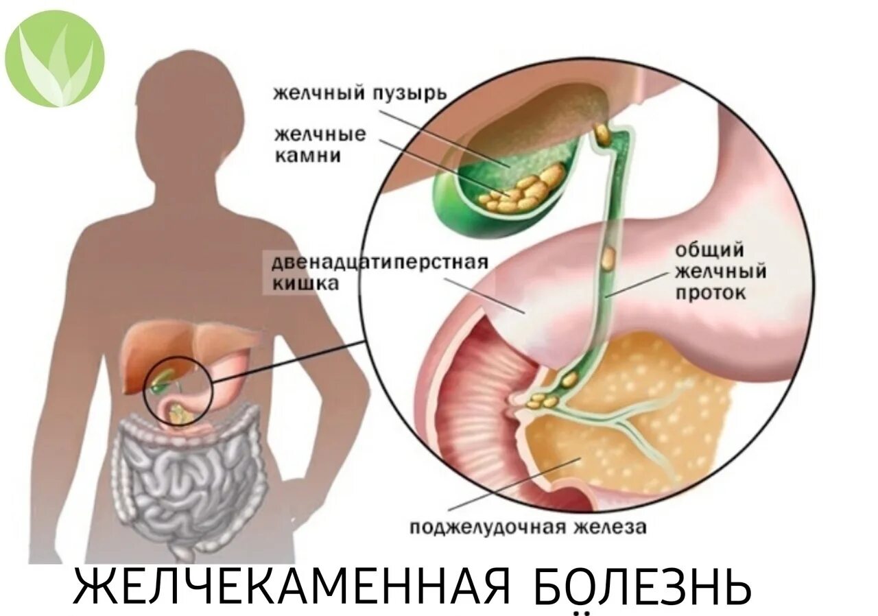 Застой желчи в желчном пузыре. Густая желчь в желчном пузыре.