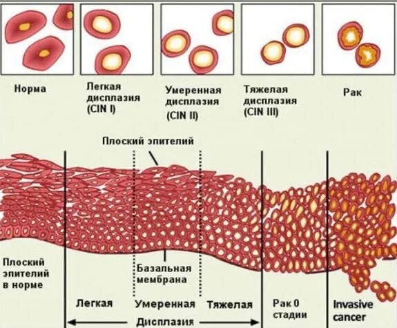 Клетки без признаков атипии. Атипия клеток шейки матки. Атипия клеток плоского эпителия. Атипические клетки в гинекологии.