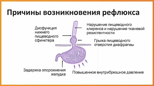 Рефлюкс диафрагмы. Причины возникновения рефлюкса. ГЭРБ симптомы. Гастро-рефлюксная болезнь. Патологический гастроэзофагеальный рефлюкс.