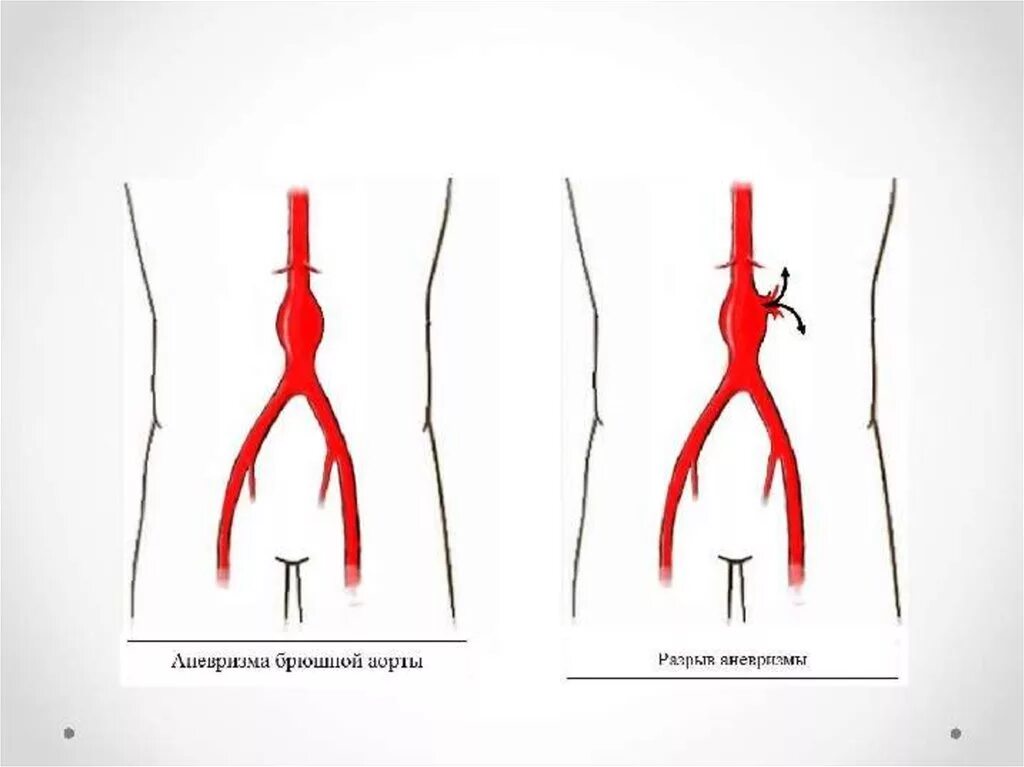 Аневризма показания к операции. Атеросклероз брюшной аорты. Аневризма брюшной аорты. Разрыв аневризмы брюшной аорты.