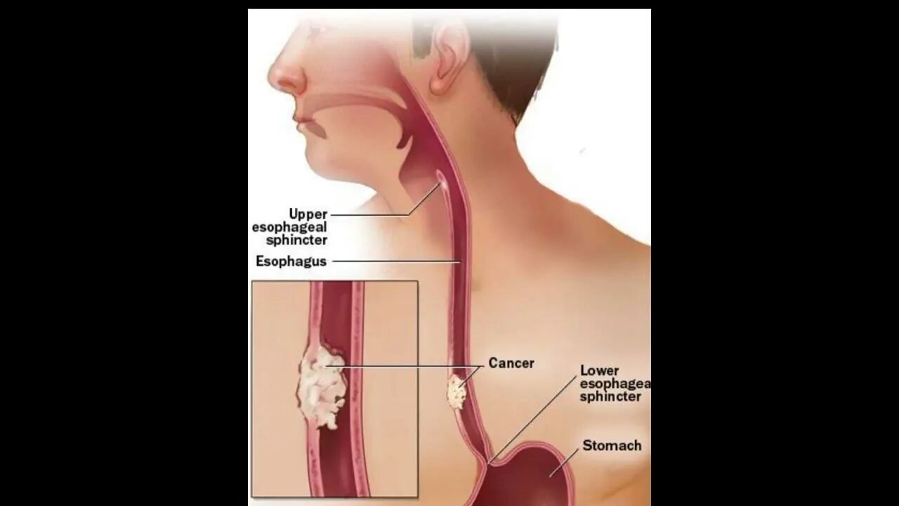 Новообразование пищевода. Боль в желудке при глотании