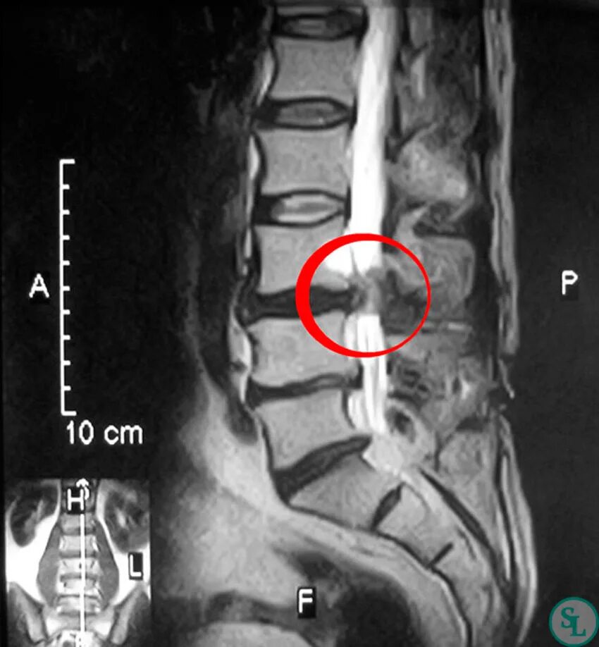 Грыжа диска l5 s1 что это. Межпозвоночные диски l3-s1. Межпозвонковые диски l2 l3 l4 l5. Грыжа диска l2-l3,l5-s1. Грыжа дисков l2\l3 - l5\s1.