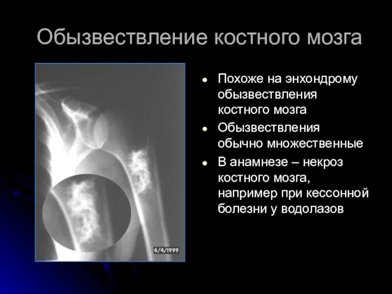 Обызвествление в проекции. Энхондрома бедренной кости кт. обызвествление костного мозга. обызвествление мягких тканей. обызвествление аортального клапана.