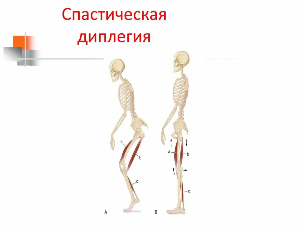 Спастическая диплегия у детей с ДЦП. Спастическая диплегия g80.1. Спастическая диплегия (синдром Литтля). ДЦП диплегия нижних конечностей.