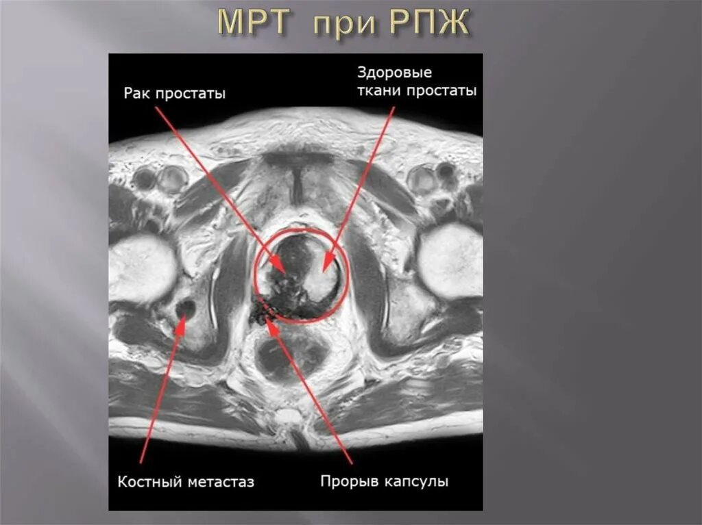 Карцинома мрт предстательной железы. Опухоли предстательной железы мрт. Предстательная железа кт анатомия. Аденома простаты мрт