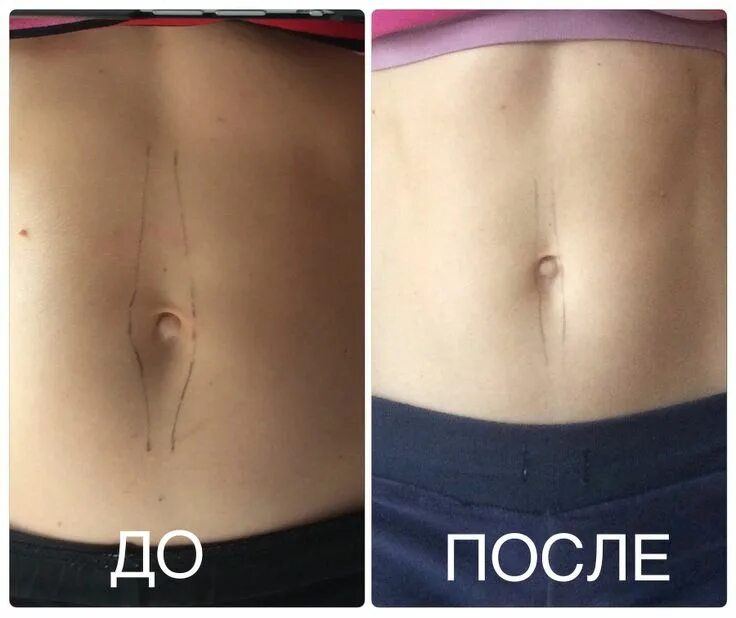 Уменьшение диастаза