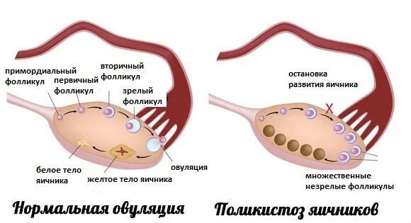 Боли после пункции фолликулов. Пункция фолликулов яичника. Гиперстимуляция яичников. Симптомы гиперстимуляции яичников.