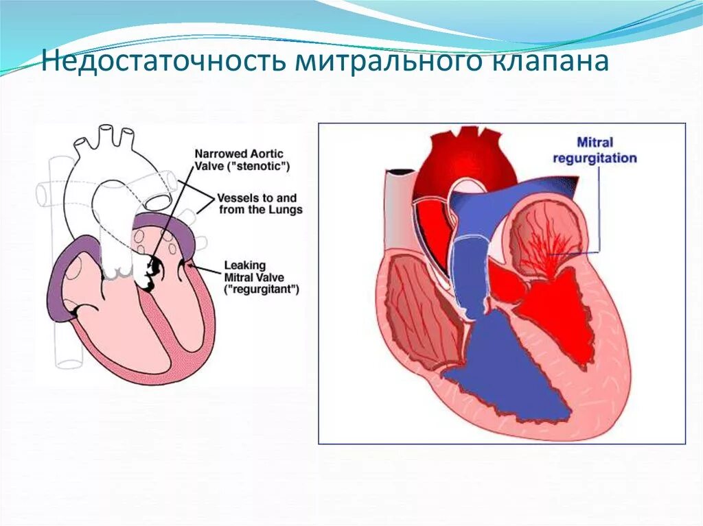 Недостаточность двустворчатого (митрального) клапана. Митральный клапан двустворчатый. Митральная клапанная недостаточность. Пороки сердца недостаточность митрального клапана. Сердечная недостаточность митрального клапана