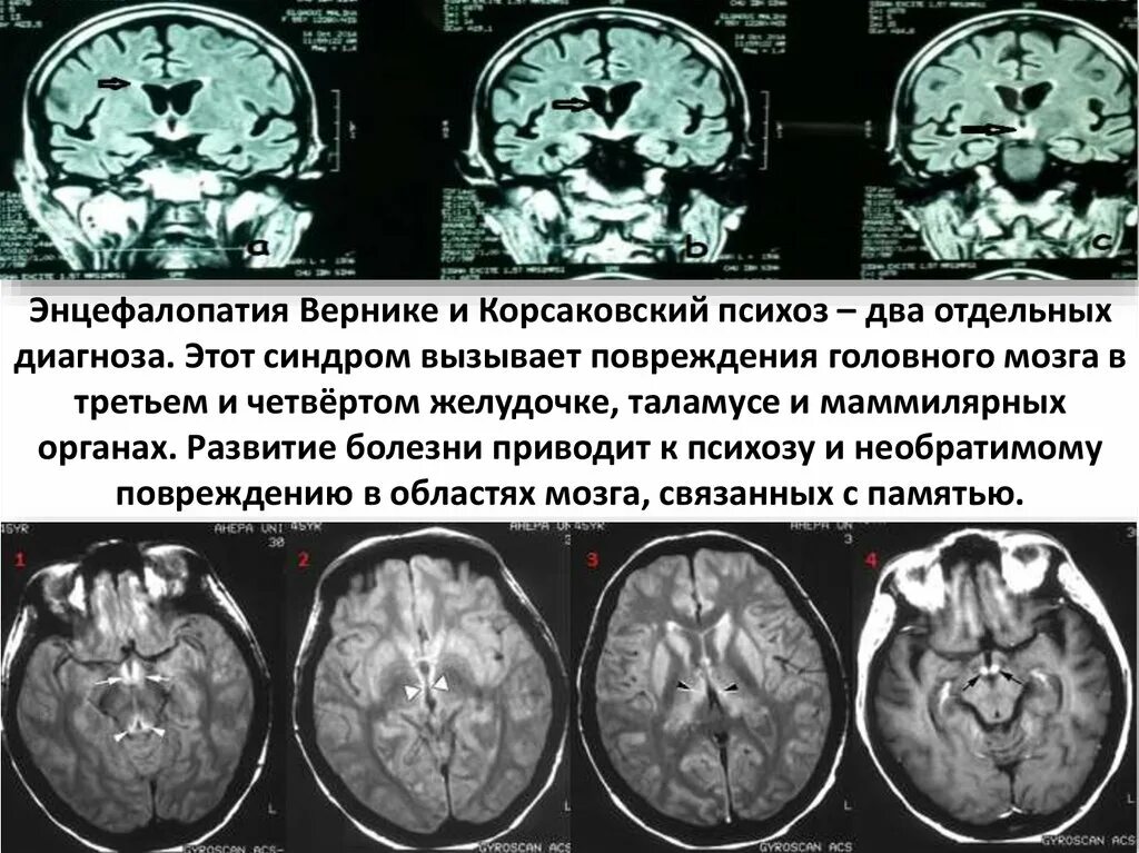 Энцефалопатия Вернике Корсакова. Энцефалопатия Вернике. Синдром Вернике-Корсакова. Энцефалопатия Вернике мрт картина.