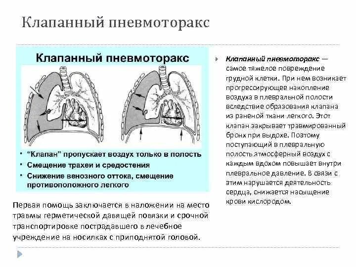 Напряженный пневмоторакс помощь