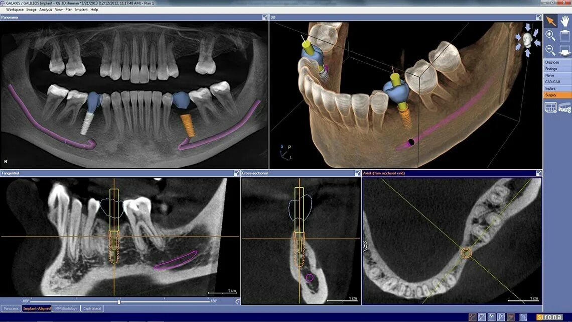 Quais os passos essenciais no processo de colocação de implantes dentários? 1-Di