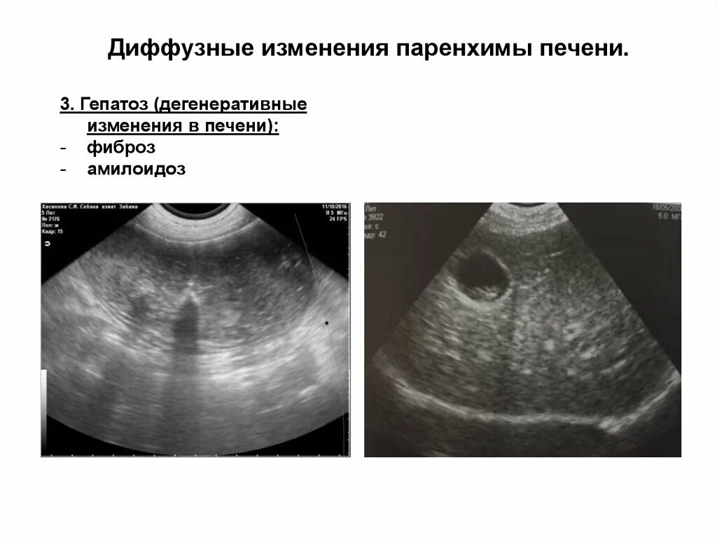 Диффузные л. Паренхима печени диффузно изменена. Неоднородная паренхима печени УЗИ. Реактивные изменения паренхимы печени на УЗИ. Диффузные изменения печени паренхимы печени.