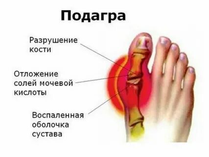 Пальцы правой ноги болят причины лечение