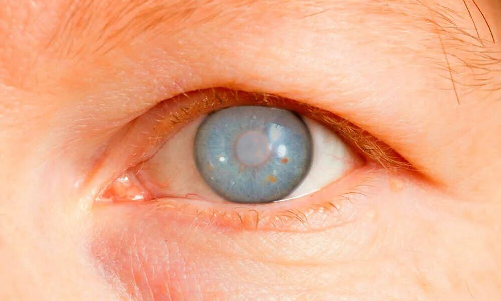 Век офтальмология. Гемералопия (куриная слепота). Куриная слепота симптомы. Закрытоугольная глаукома глаза.