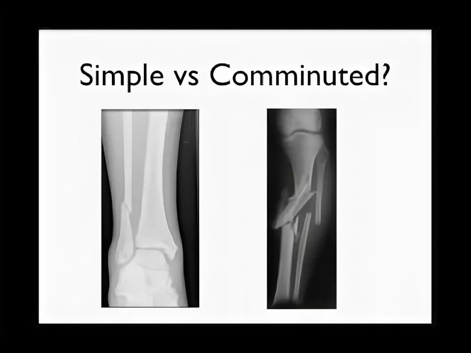 A fracture is a broken bone. A fracture is a broken bone