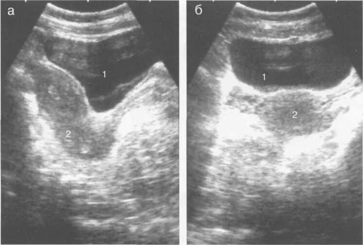 Расположение матки и мочевого пузыря. УЗИ мочевого пузыря анэхогенное. Сонограмма мочевого пузыря. Ультразвуковая анатомия мочевого пузыря. Видно ли матку на УЗИ мочевого пузыря.