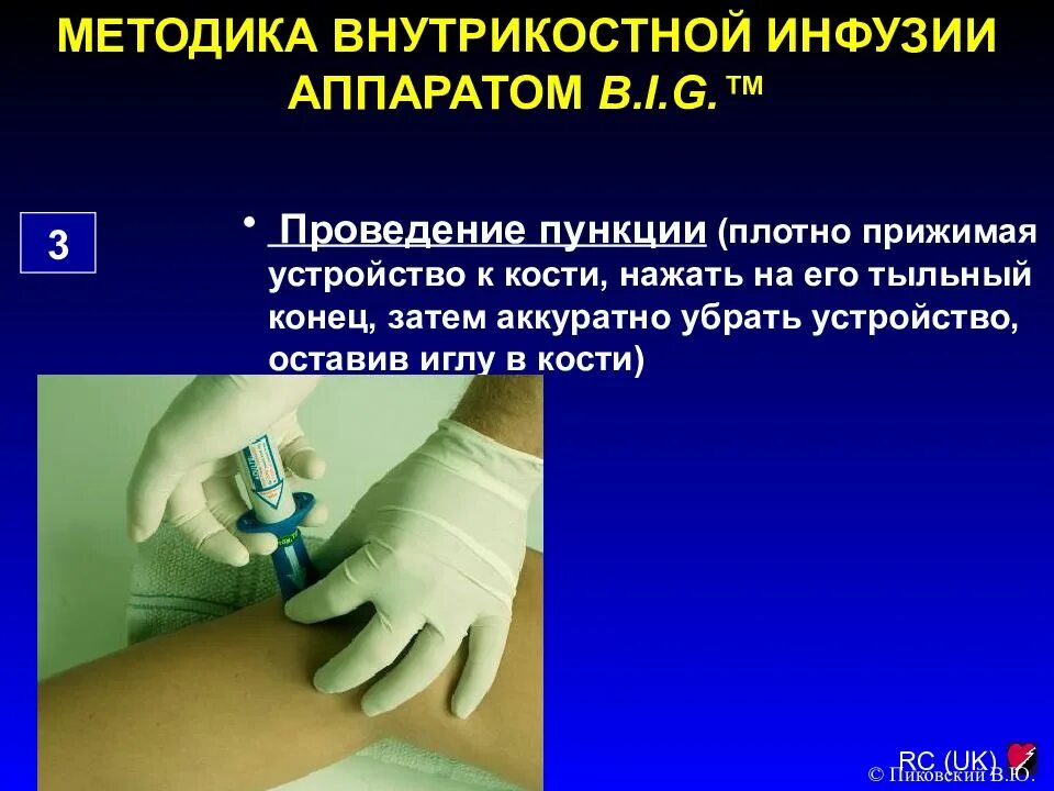 Внутрикостное введение лекарственных. Внутрикостное введение. внутрикостный катетер. внутрикостные инфузии техника проведения. внутрикостное введение лекарственных средств.