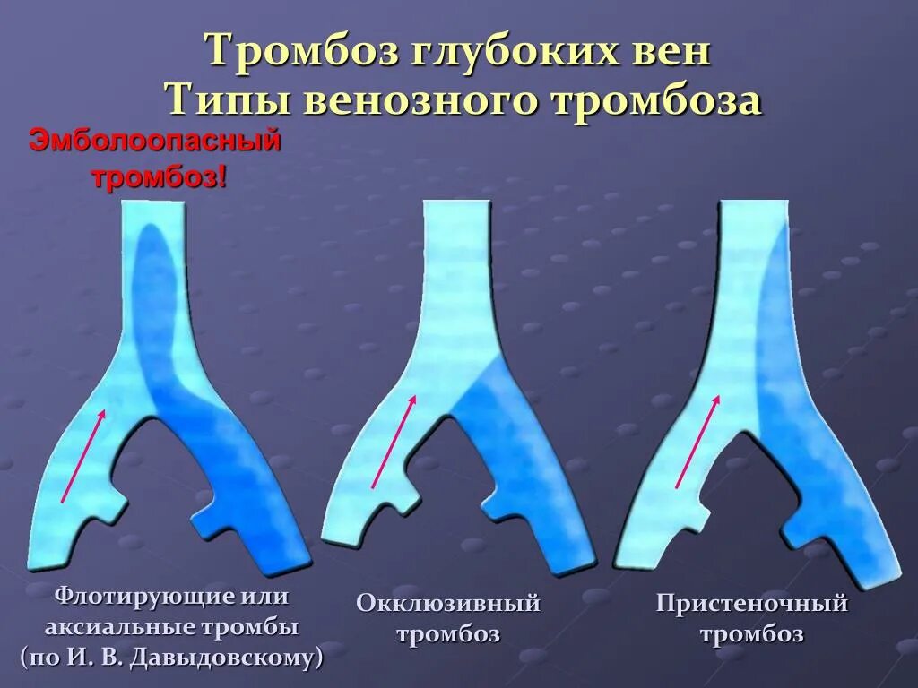 Окклюзионный и неокклюзионный тромбоз. Флотирующий тромбофлебит. Типы тромбов флотирующий. Пристеночный тромбоз