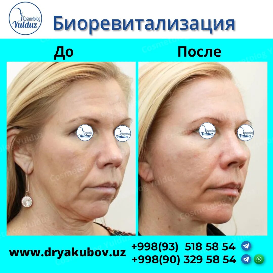 Биоревитализация лица в медцентре BONNE CLINIQUE