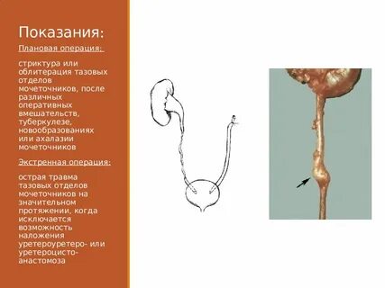 Пластика мочеточника