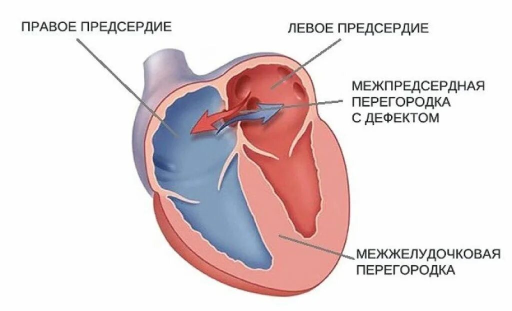 Врожденные пороки сердца дефект межпредсердной перегородки. Первичный дефект межпредсердной перегородки. дефект предсердной перегородки у ребенка. порок межпредсердной перегородки. дефект межпредсердной перегородки у новорожденного.
