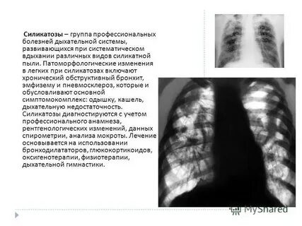 Силикоз это